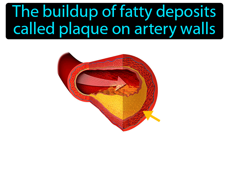 Atherosclerosis Definition with no text